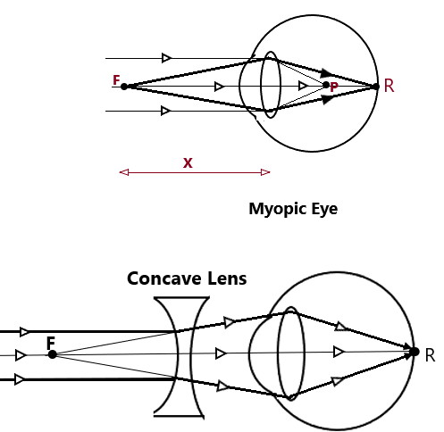 Defects of vision