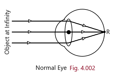 Defects of vision